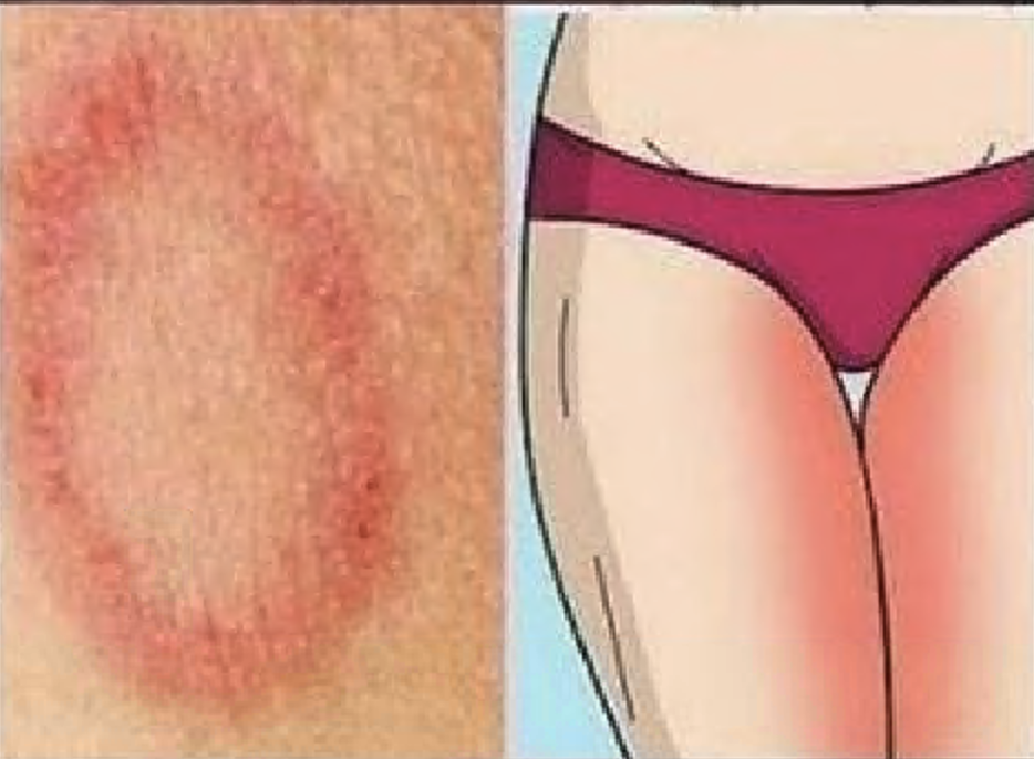 REASONS FOR GETTING SKIN FUNGUS AND HOW TO PREVENT IT