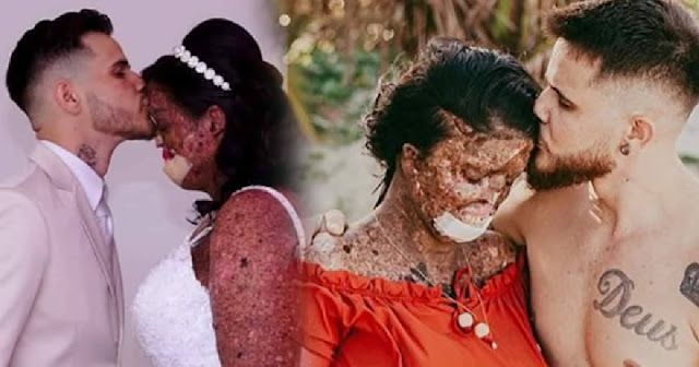 Woman With Rare Skin Condition Gets Trolled—Overcomes Negativity And Finds True Love