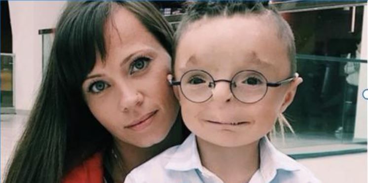 Woman adopts a boy no one wanted to adopt: see what he looks like now