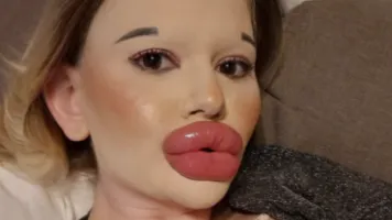 A 25-Year Old Woman from Bulgaria Undergoes More than 27 Procedures to Have the Biggest Lips on Earth