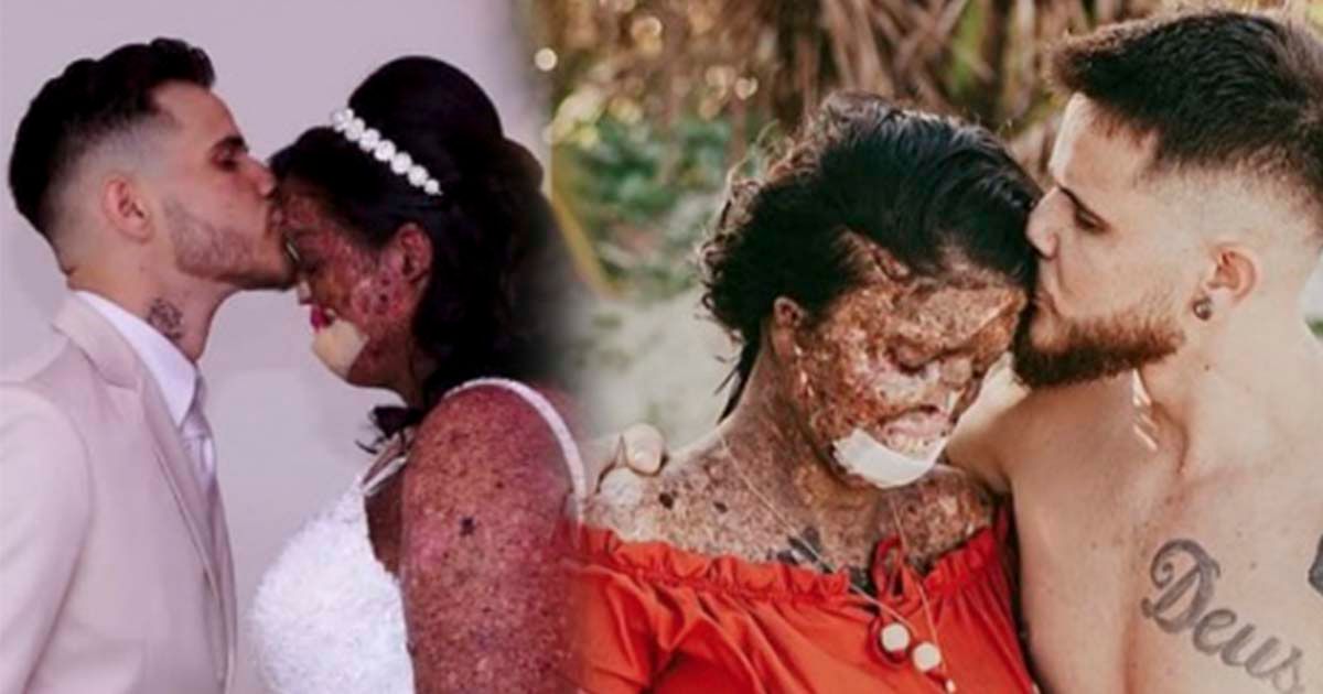 Woman with rare skin condition overcomes negativity and finds true love