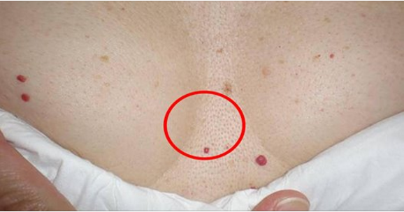 DO YOU HAVE THESE RED SPOTS ON VARIOUS PARTS OF YOUR BODY SHOULD YOU WORRY – WHAT SHOULD YOU DO