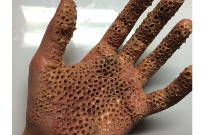 A new kind of deadly bug that punctures hands with many tiny holes?